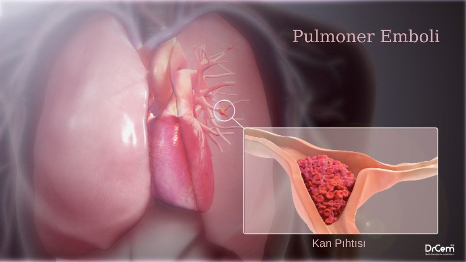 Pulmoner Emboli görseli - DrCem hastalık rehberi